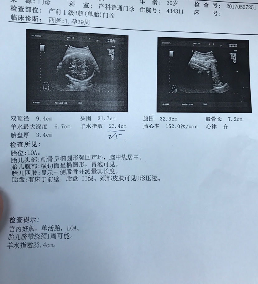 做供卵试管生双胞胎风险大吗