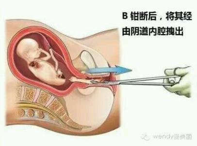 中信湘雅一代试管费用多少